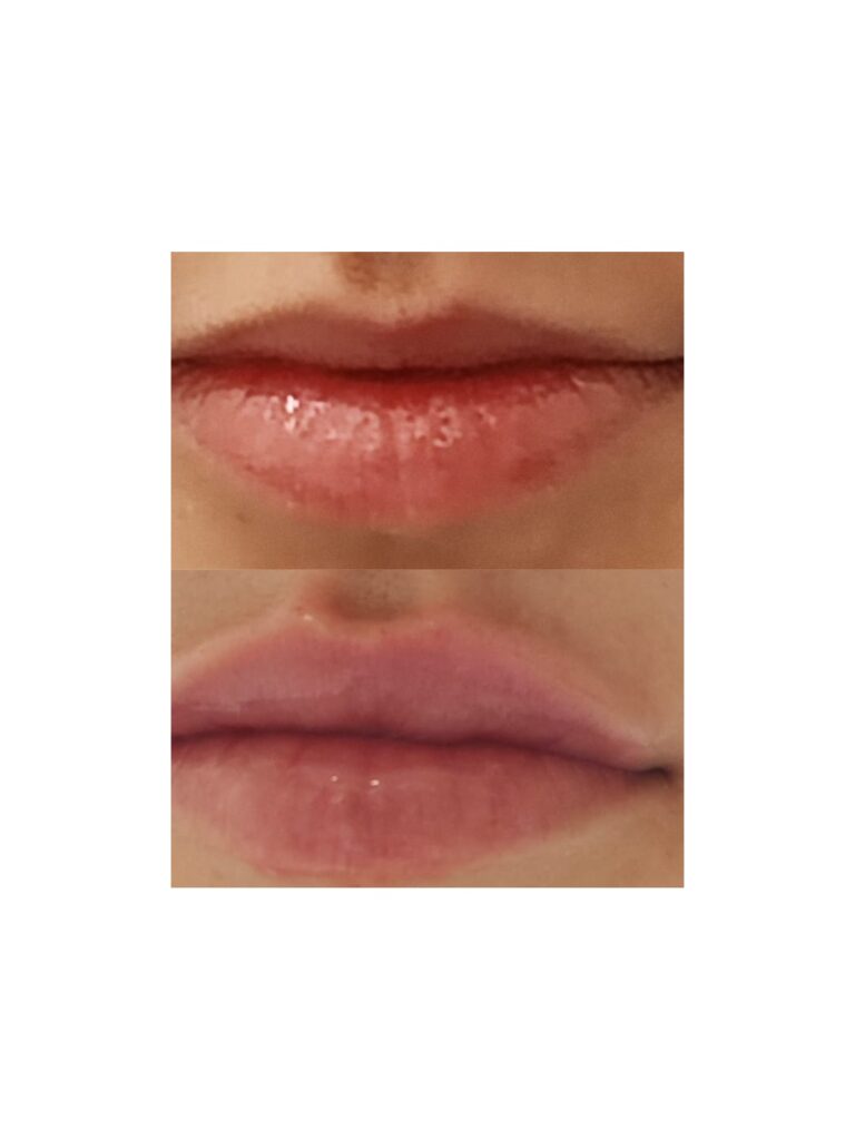 augmentare buze cu acid hialuronic