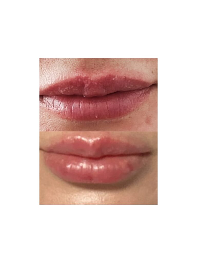 augmentare buze cu acid hialuronic