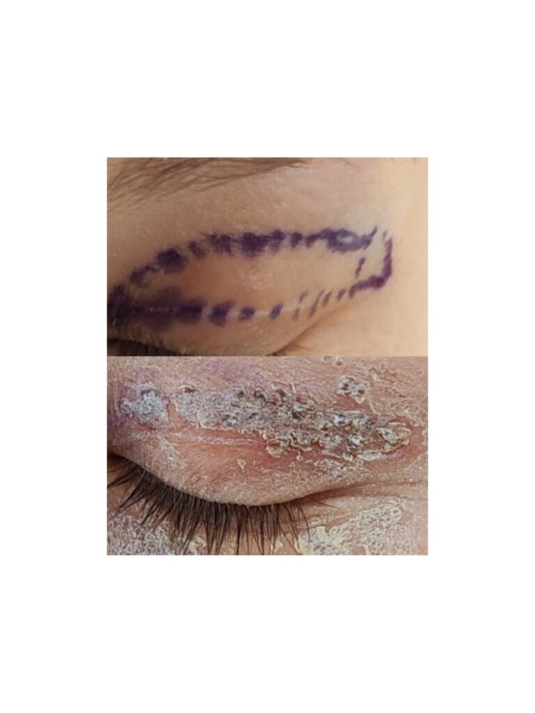 Blefaroplastie cu jett plasma lift