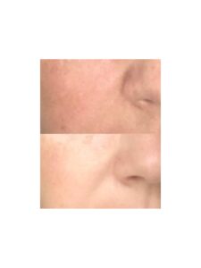 Biorevitalizare cu acid hialuronic si aminoacizi
