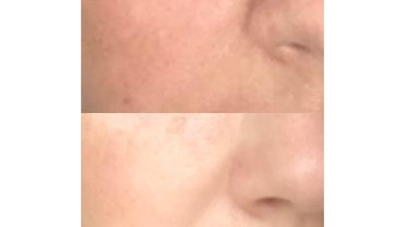 Biorevitalizare cu acid hialuronic si aminoacizi