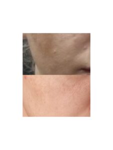 Biorevitalizare cu substante de depigmentare