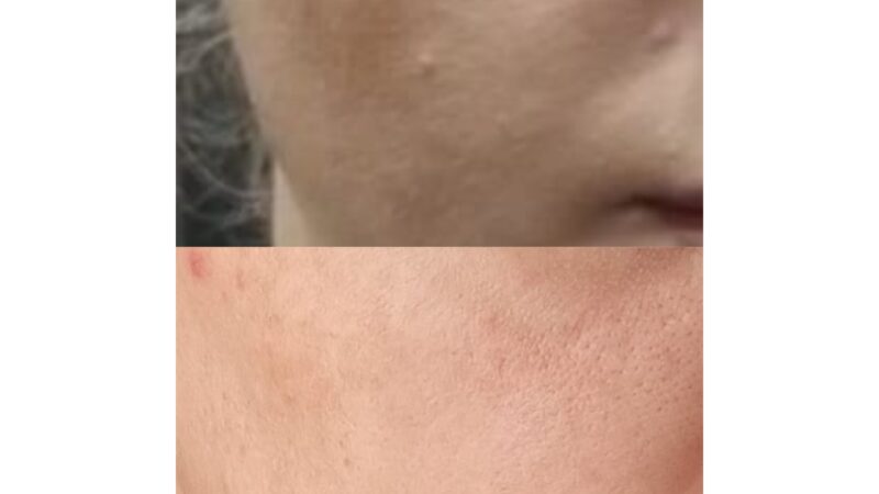 Biorevitalizare cu substante de depigmentare