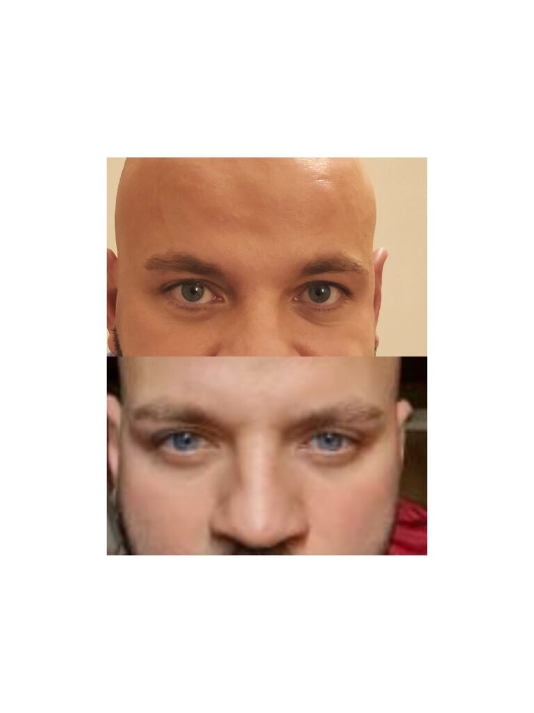 Blefaroplastie chirurgicala